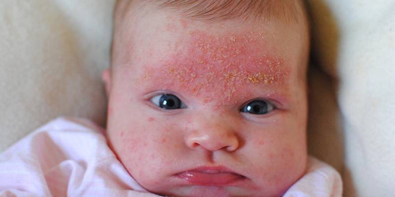 Симптомы и лечение экземы у детей: фото вирусной и других форм патологии на разных стадиях