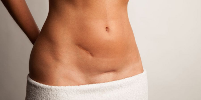 Боли после кесарева сечения: причины, сколько времени болит живот и ощущается онемение, что делать?