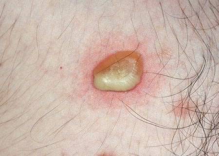 Везикулопустулез у детей - фото патологии у новорожденных, симптомы, причины, лечение