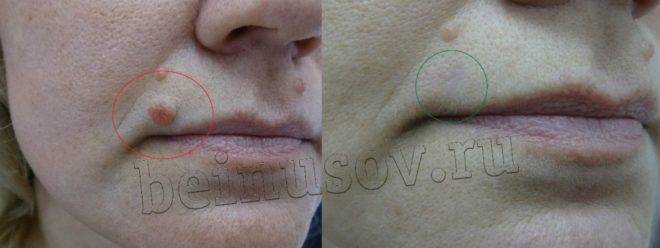 Когда у детей появляются родинки: в каком возрасте, можно ли удалять, к кому обратиться?