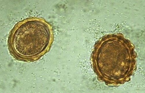 Глисты у детей: симптомы и лечение гельминтоза - как понять, есть ли паразиты в организме?