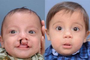 Волчья пасть у детей и заячья губа: причины патологий, фото до и после операции