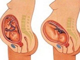 Как понять, что опустился живот перед родами: на какой неделе происходит опущение, когда рожать?