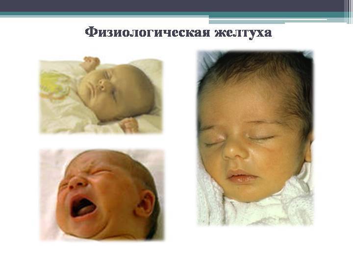 Патологическая желтуха у новорожденных: симптомы и последствия