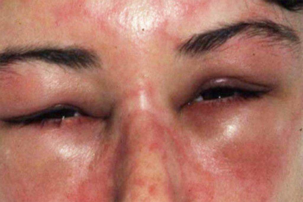 Ребенка укусил клещ: что делать, через какое время видны симптомы - фото и признаки укуса