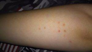 Синяки на ногах у ребенка без причины - что это и почему постоянно появляются пятна?