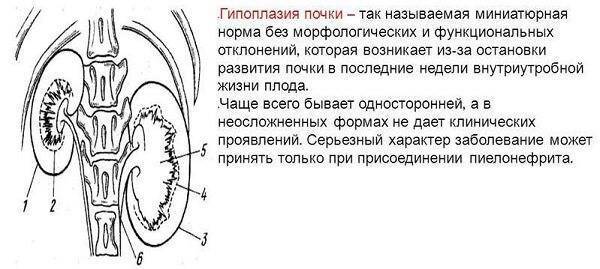 Гипоплазия почки у ребенка: причины, симптомы и лечение