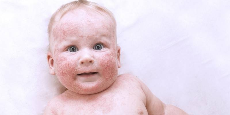 Симптомы и лечение экземы у детей: фото вирусной и других форм патологии на разных стадиях