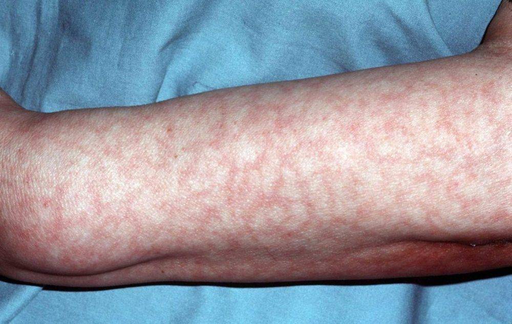 Мраморная кожа у грудничка: причины мраморности кожных покровов и лечение