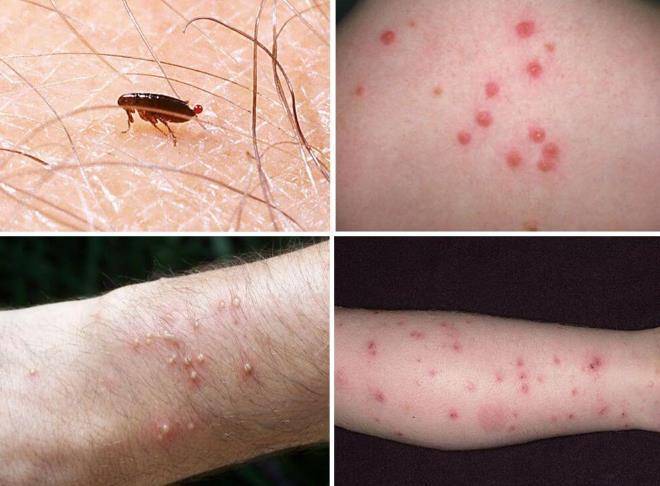 Мазь от укусов насекомых для детей: чем лечить опухоль и покраснение, как снять отек?