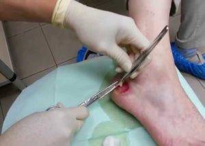 Ожог у ребенка: лечение термических повреждений разной степени и первая помощь в домашних условиях