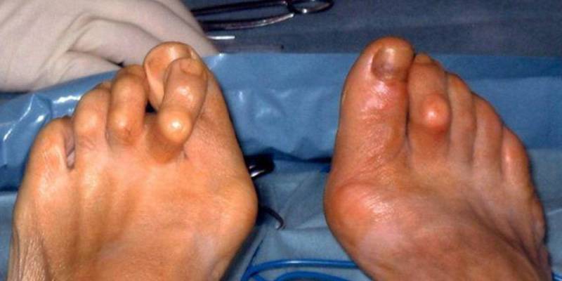 Вальгусная деформация стопы у детей (плосковальгусная) с фото: способы лечения искривления