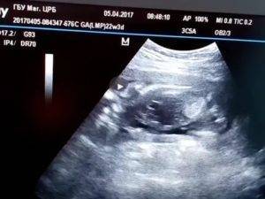 Гиперэхогенный кишечник у плода: что это такое, каковы последствия, что нужно делать?