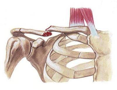 Перелом ключицы у новорожденного при родах: последствия для ребенка
