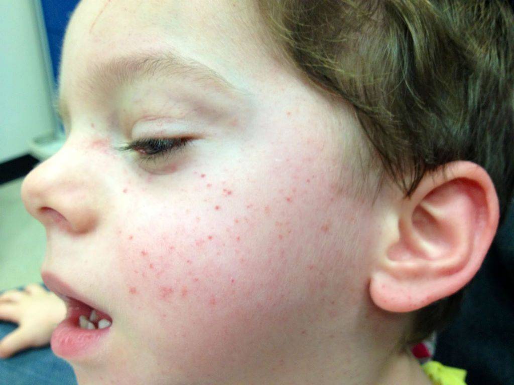 Прыщики на теле у ребенка: виды высыпаний с фото и пояснениями, причины и лечение