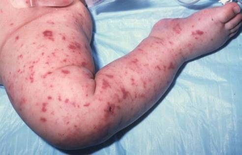 Менингококковая инфекция у детей: симптомы и лечение, профилактика, фото сыпи