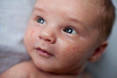 Сыпь у ребенка на попе - фото прыщей с пояснениями, причины аллергии и сухой кожи, лечение
