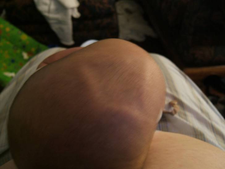 Родничок у новорожденных: когда зарастает темечко - нормы по месяцам