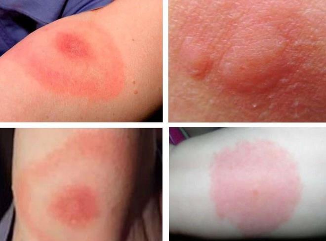 Мазь от укусов насекомых для детей: чем лечить опухоль и покраснение, как снять отек?