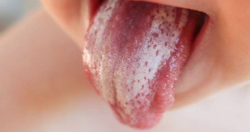 У ребенка на языке пятна: красные, как ожог (фото, диагноз, лечение и причины)