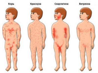 Сыпь у ребенка на попе - фото прыщей с пояснениями, причины аллергии и сухой кожи, лечение