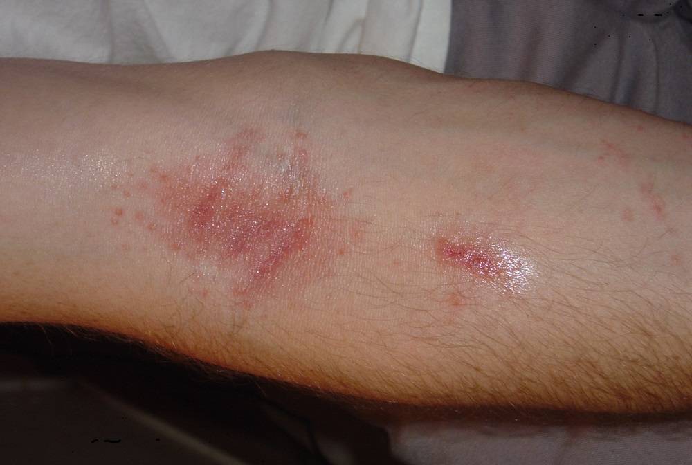 Шершавые пятна на теле у ребенка (на коже ног и рук, на спине и лице): фото