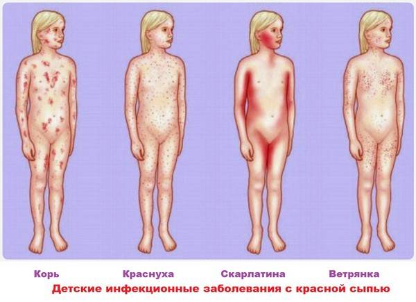 Сыпь в паху у ребенка - раздражение в интимной зоне, покраснение и зуд на половых органах
