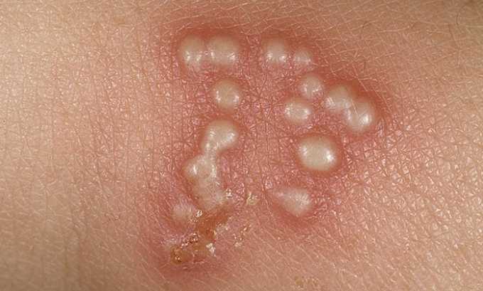 Герпес при грудном вскармливании у кормящей мамы: на губе, груди, генитальный