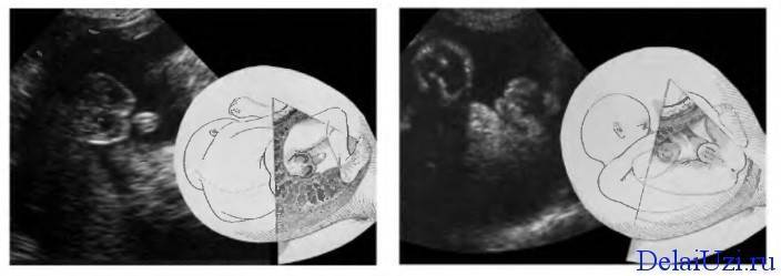 Фото УЗИ мальчика и девочки: различия и общие черты плодов разного пола