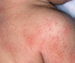 Псевдотуберкулез у детей: симптомы и лечение начальной и последующих стадий