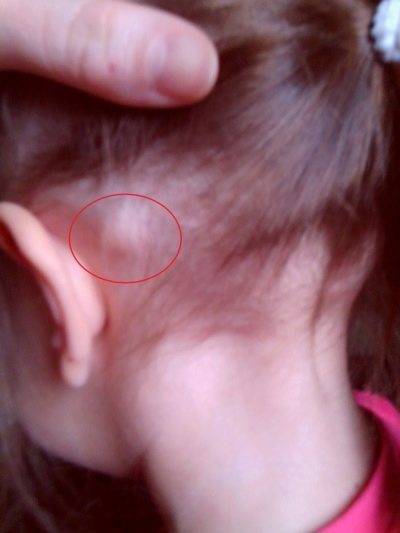 Лимфоузлы при ветрянке у детей: причины воспаления и появления шишек за ушами