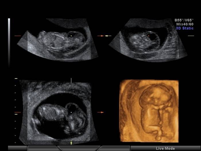 Как алкоголь влияет на спермограмму и состояние сперматозоидов, стоит ли выпивать перед процедурой?