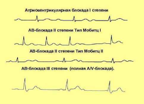 Нарушение внутрижелудочковой проводимости сердца у детей на ЭКГ: что это и как лечится?