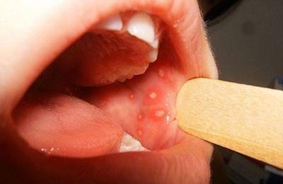 Стоматит в горле у ребенка (с фото): способы лечения язвочек на миндалинах