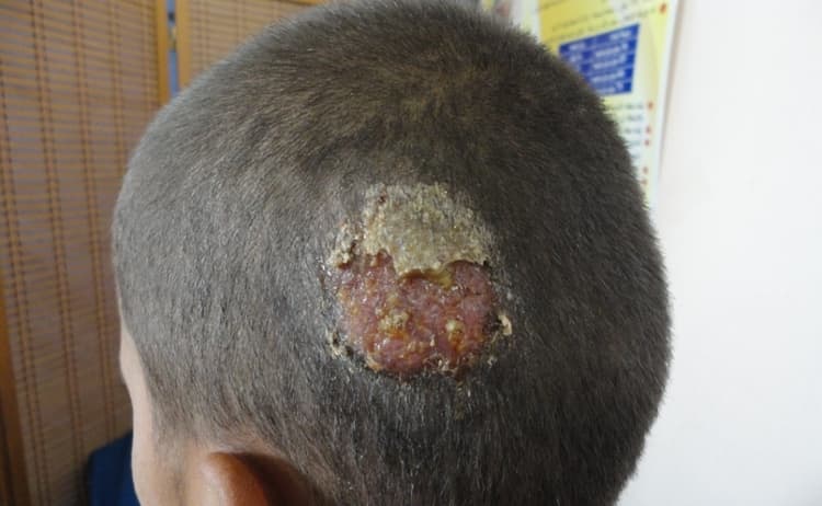 Стригущий лишай у детей на голове: фото, признаки и лечение в домашних условиях