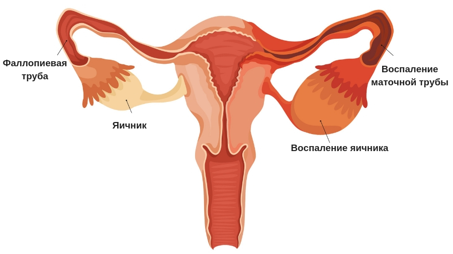 Кесарево сечение при тазовом предлежании: когда делают, как проходит, какие плюсы и минусы операции?