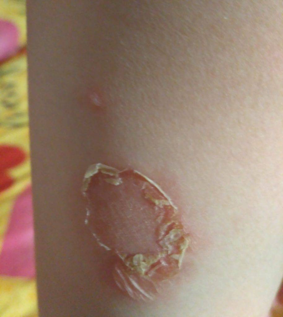 Шершавые пятна на теле у ребенка (на коже ног и рук, на спине и лице): фото