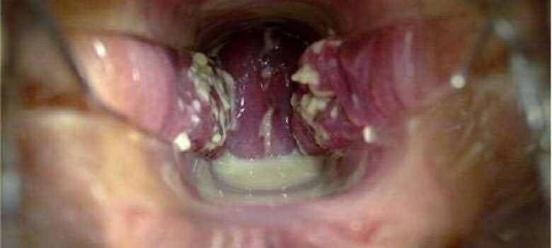 Можно ли при молочнице забеременеть: возможно ли зачатие, какой будет беременность?