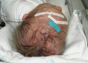 Кефалогематома у новорожденных на голове: последствия, лечение, пункция (фото)