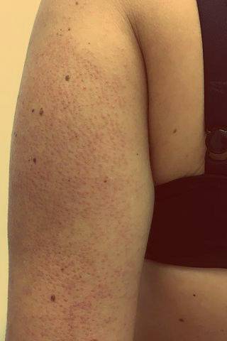 Шершавые пятна на теле у ребенка (на коже ног и рук, на спине и лице): фото