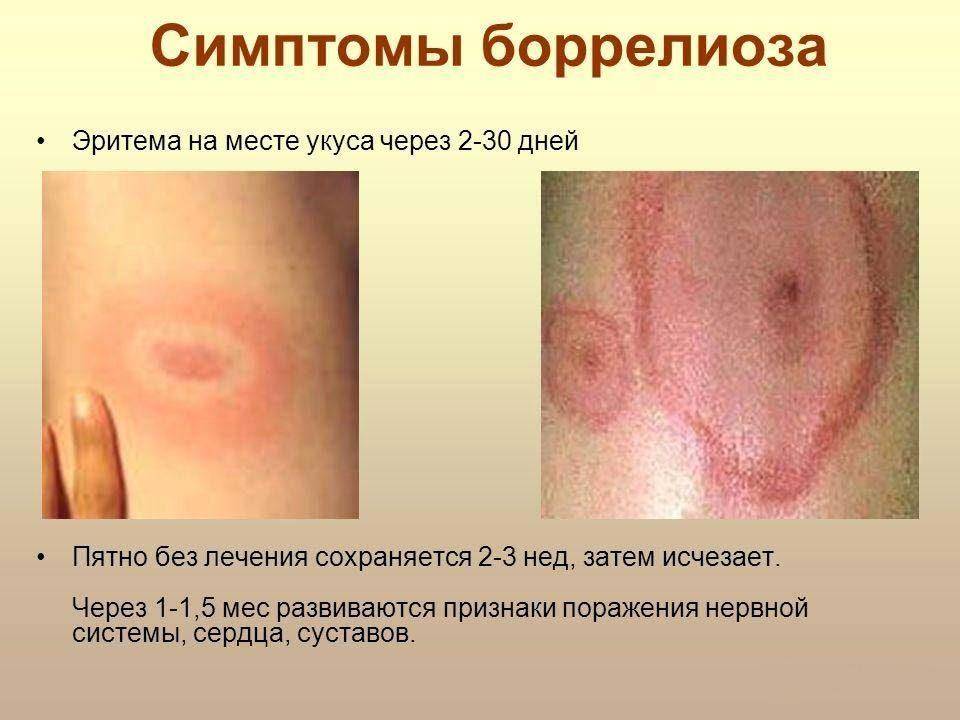 Профилактика боррелиоза у детей после укуса клеща, симптомы болезни Лайма, лечение и последствия