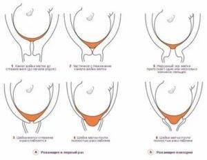 Но-Шпа перед родами при схватках для размягчения шейки матки и провоцирования процесса, дозировка