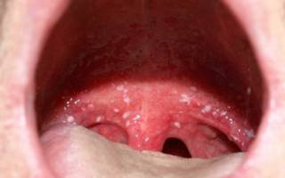 Красные точки во рту у ребенка - сыпь на слизистой неба и горла: фото с пояснениями