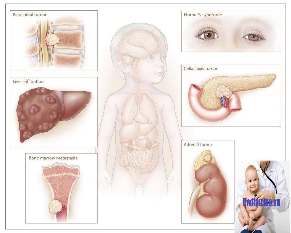 Нейробластома у детей: симптомы и причины, стадии, выживаемость и прогноз