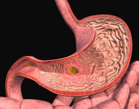 Пилороспазм у новорожденных: симптоматика, диагностика и лечение у детей, отличие от пилоростеноза