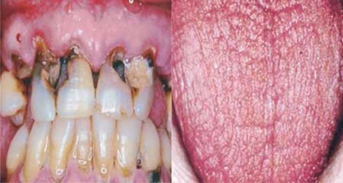 Сухость во рту у детей - причины дискомфорта, способы лечение ксеростомии