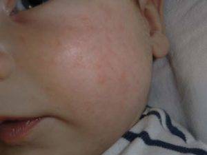 Аллергия на витамин Д у грудничков: фото, симптомы, может ли быть негативная реакция у детей?