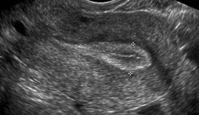 Тонкий эндометрий и беременность: вероятность зачатия и вынашивания ребенка, норма толщины в цикле