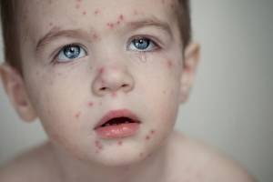 Можно ли гулять при ветрянке у детей без температуры, когда разрешено купаться?