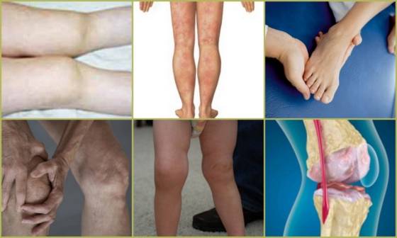 Остеопороз у детей: симптомы и лечение ювенильной формы патологии